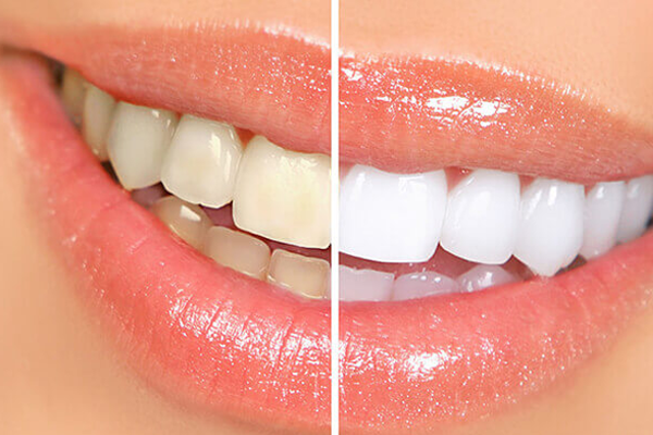 Blanqueamiento Dental