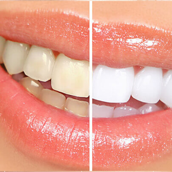 Blanqueamiento Dental Blanqueamiento Dental