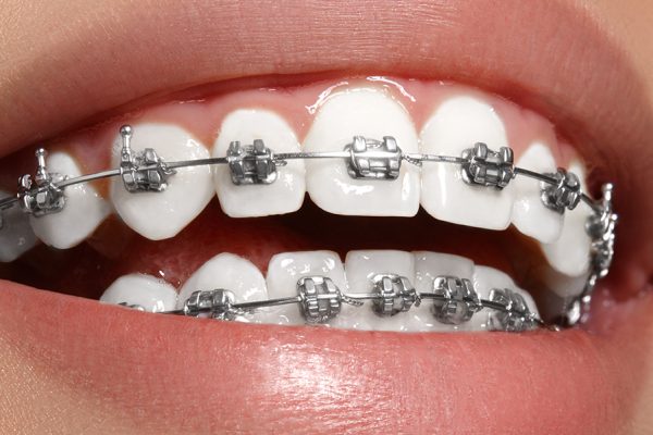 cuidar-los-dientes-durante-tratamiento-ortodoncia